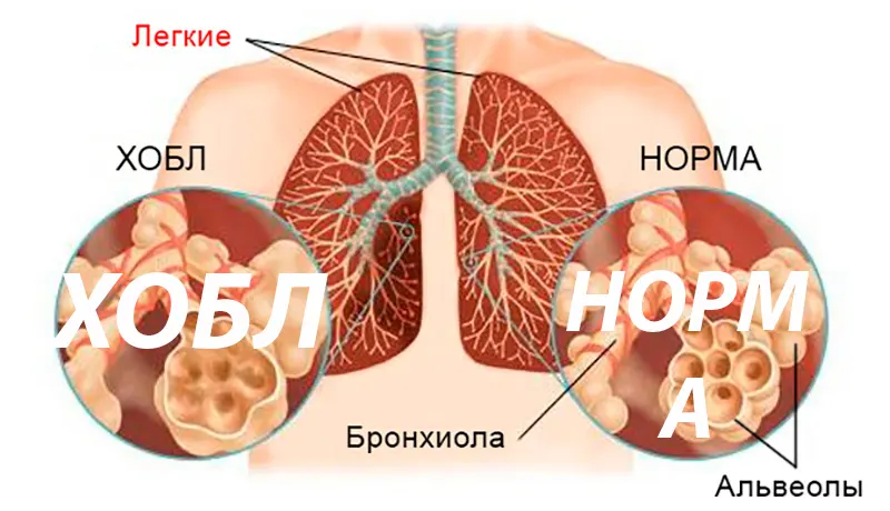 Симптомы ХОБЛ